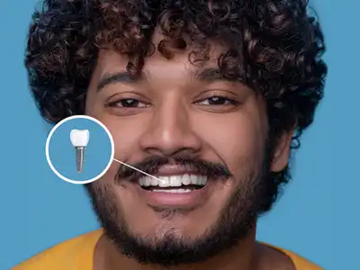 Dental Implants at Anna Nagar Dental Clinic