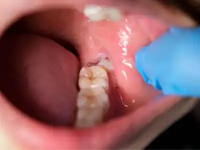 Wisdom Tooth Removal in Anna Nagar