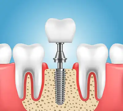 Dental Implants in Anna Nagar