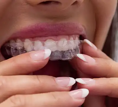 Invisalign Treatment in Anna Nagar