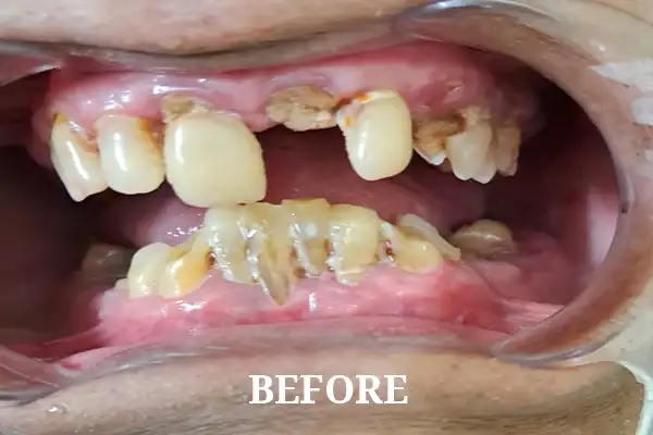 This case involved a full mouth rehabilitation, combining conservative and cosmetic dental treatments.