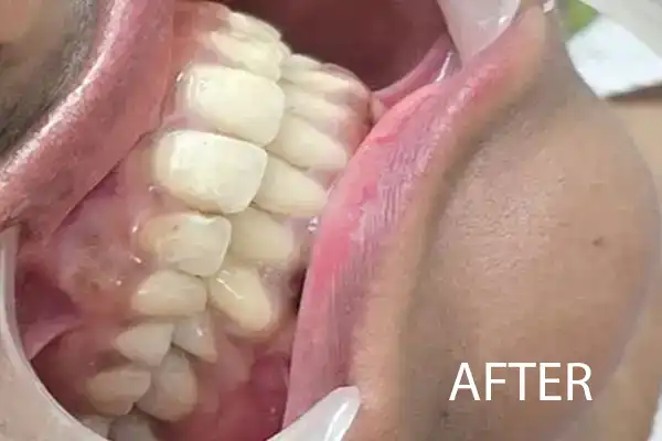 Aesthetic Smile Restoration