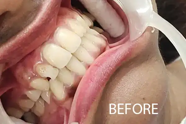 Aesthetic Smile Restoration