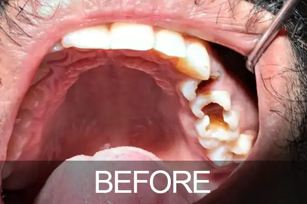 At Anna Nagar Dental Clinic, Dr. K. Seetha Lakshmi recently addressed a compelling case that underscores the importance of conservative dental treatment delivered with precision and efficiency