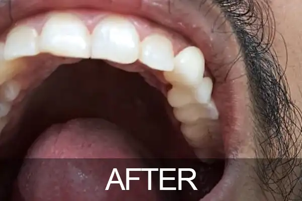 At Anna Nagar Dental Clinic, Dr. K. Seetha Lakshmi recently addressed a compelling case that underscores the importance of conservative dental treatment delivered with precision and efficiency