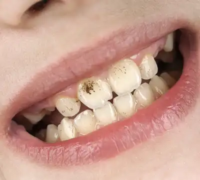 Tooth Discoloration: Causes, Types & Treatment Options at Anna Nagar Dental