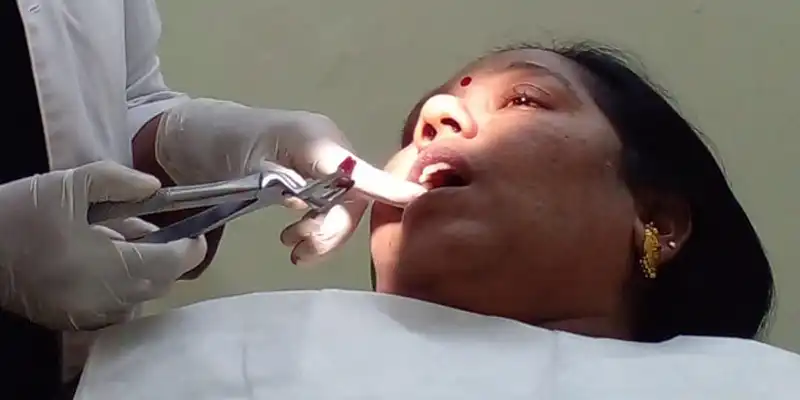 This case study demonstrates our approach to addressing such issues with care and precision, ensuring a painless wisdom tooth extraction through a well-executed impaction surgery.