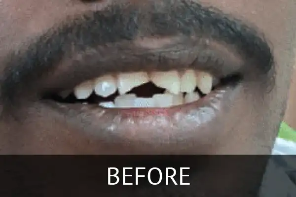 RTA Case Summary: This case study outlines the successful treatment of a young male patient with complex dental trauma resulting from a road traffic accident.