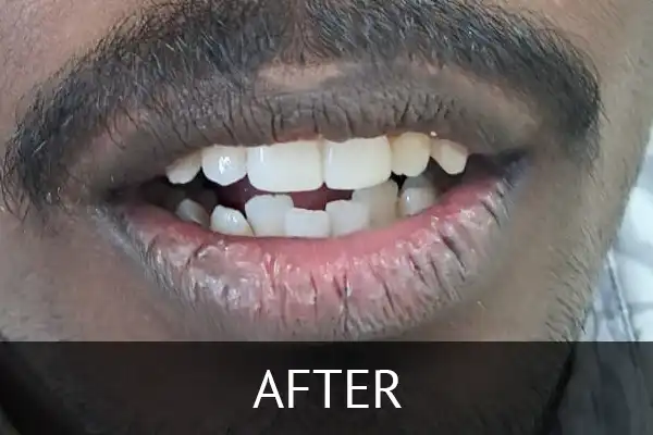 RTA Case Summary: This case study outlines the successful treatment of a young male patient with complex dental trauma resulting from a road traffic accident.