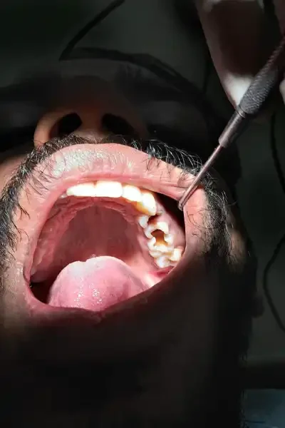 cae-study-conservative-dentistry-04 The patient experienced first-hand the benefits of conservative, comprehensive, and cost-effective dental treatment at Anna Nagar Dental Clinic.