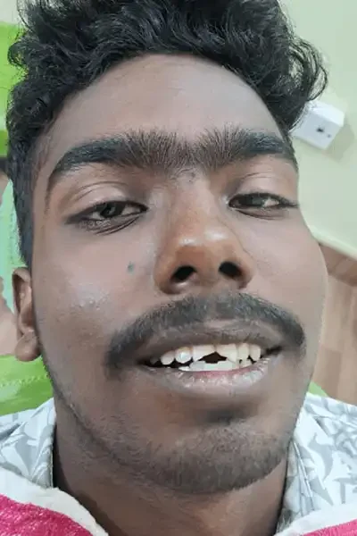 RTA Case Summary: This case study outlines the successful treatment of a young male patient with complex dental trauma resulting from a road traffic accident.